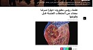 Информационное агентство Sputnik рассказало о разработках ученых СГМУ в области кардиологии 